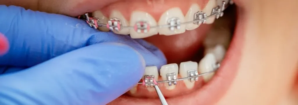 Colores de ligas para brackets: ¿cuál elegir?