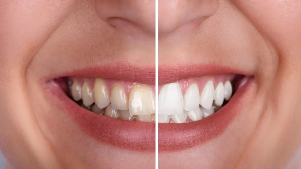 Blanqueamiento Dental: Guía completa