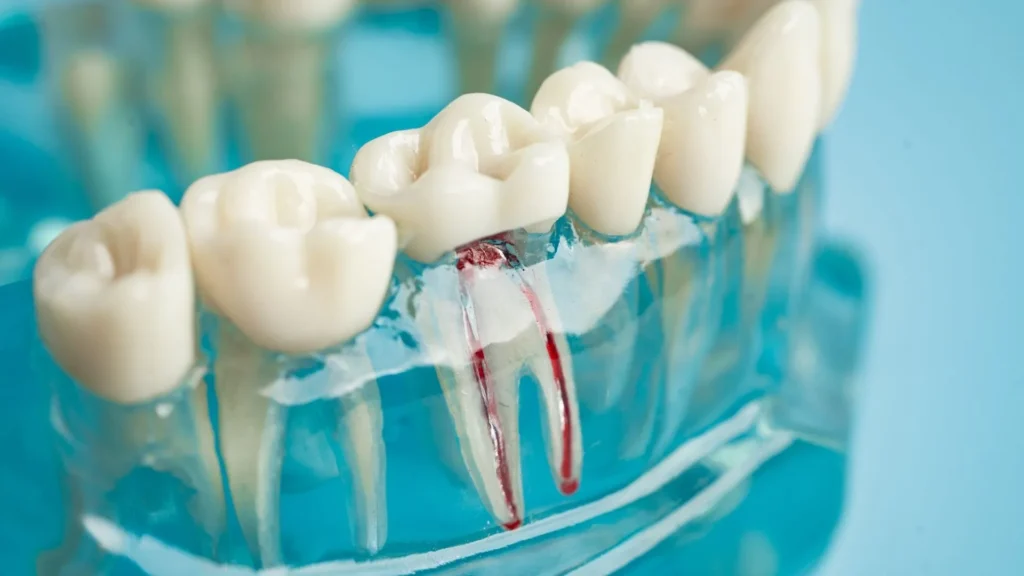 Tratamiento de conducto: Guía completa para ti