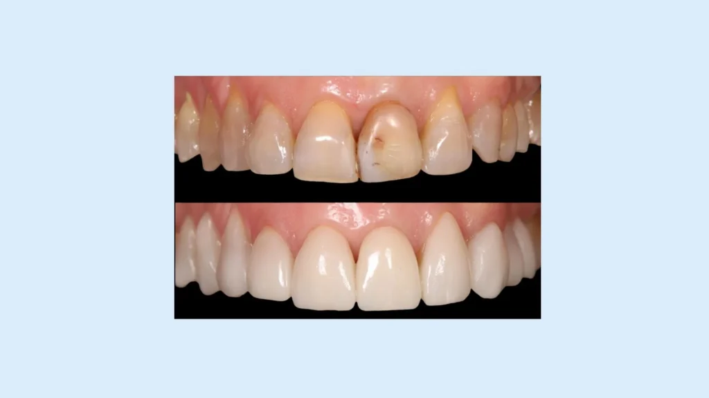 Reconstrucción dental: qué es y cuándo se hace