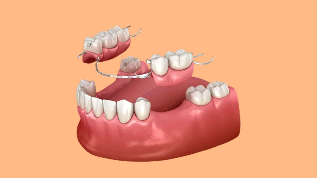 Prótesis dentales: qué son y cuándo necesitas una