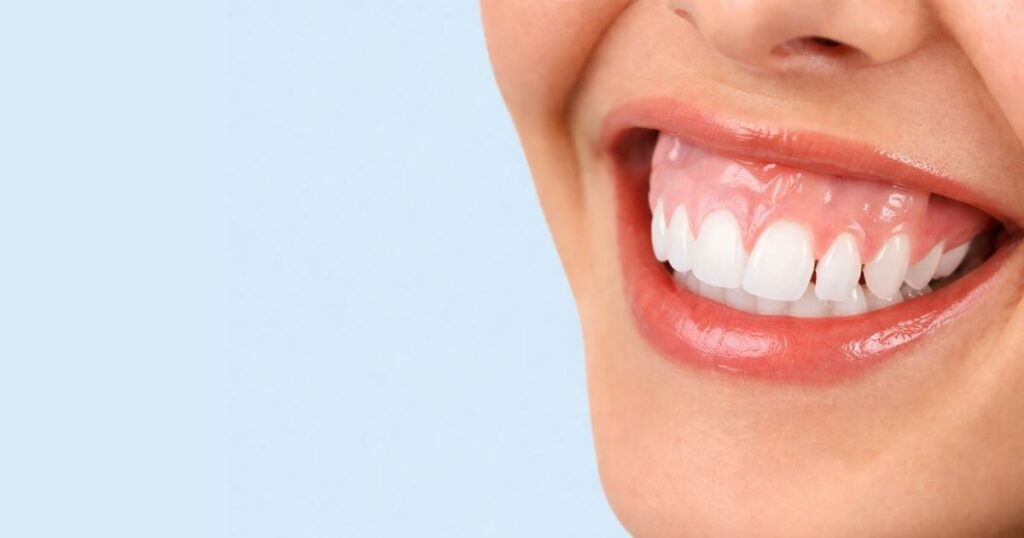 Corregir sonrisa gingival