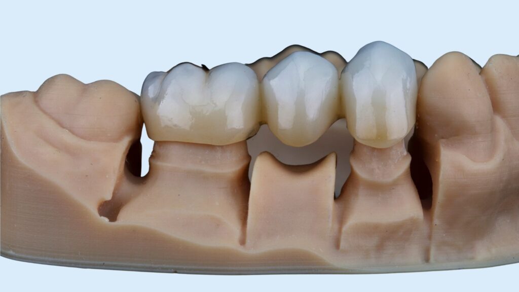 Cuánto dura una corona dental