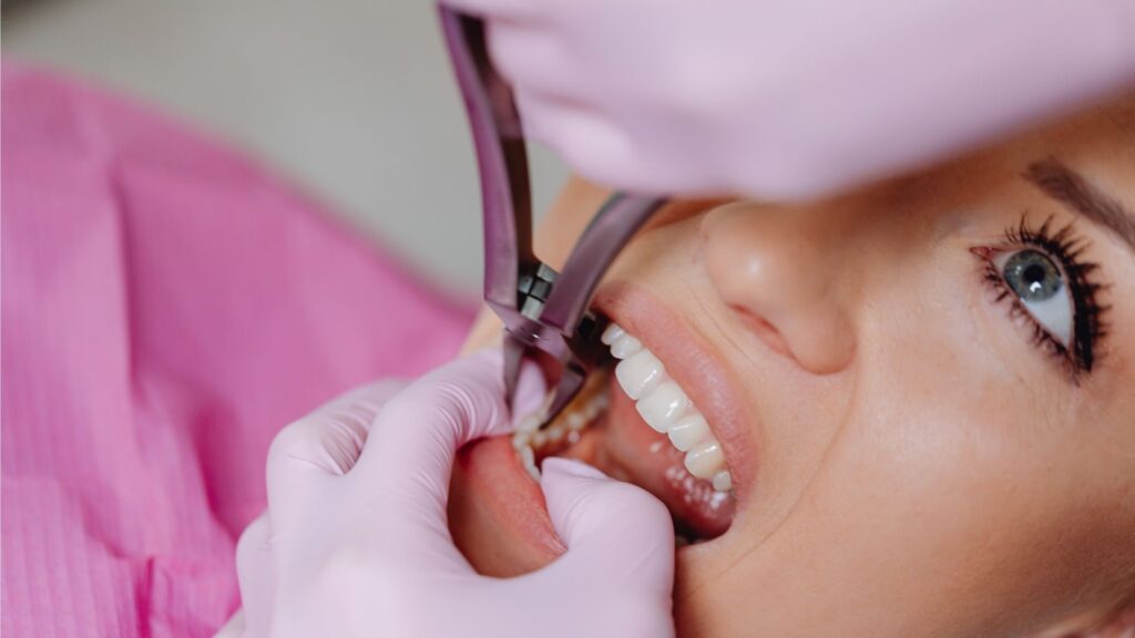 Extracción de dientes: cuándo es necesaria, procedimiento y precio en Chile