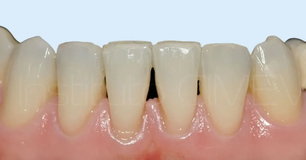 Troneras dentales: qué son y cómo pueden afectar tu sonrisa