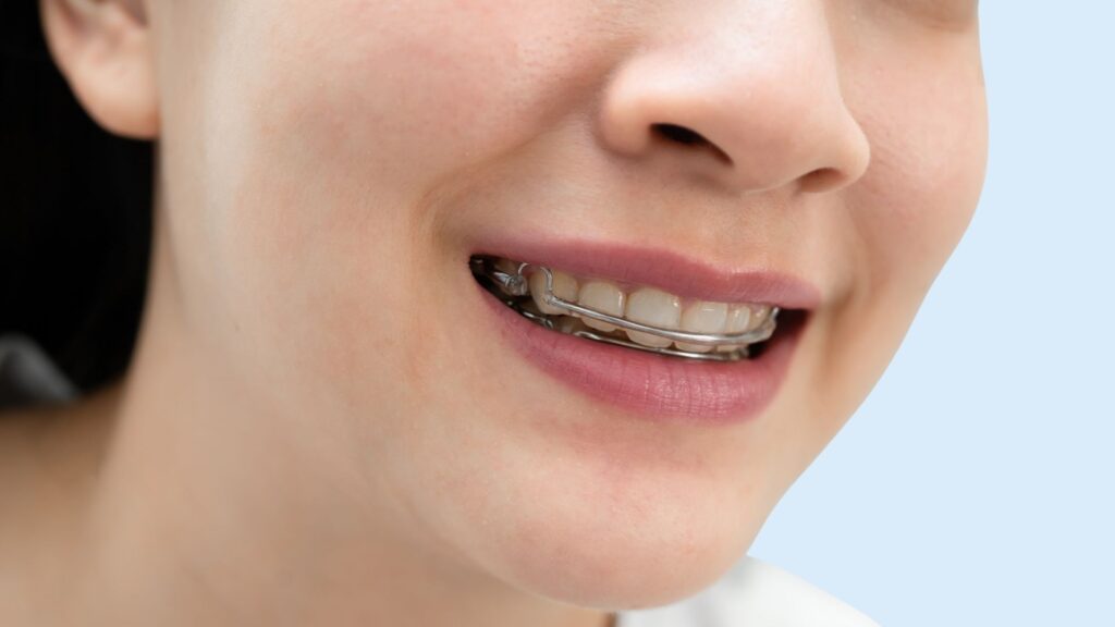 Retenedores dentales removibles