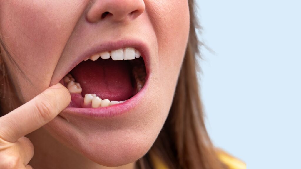 perdida de dientes