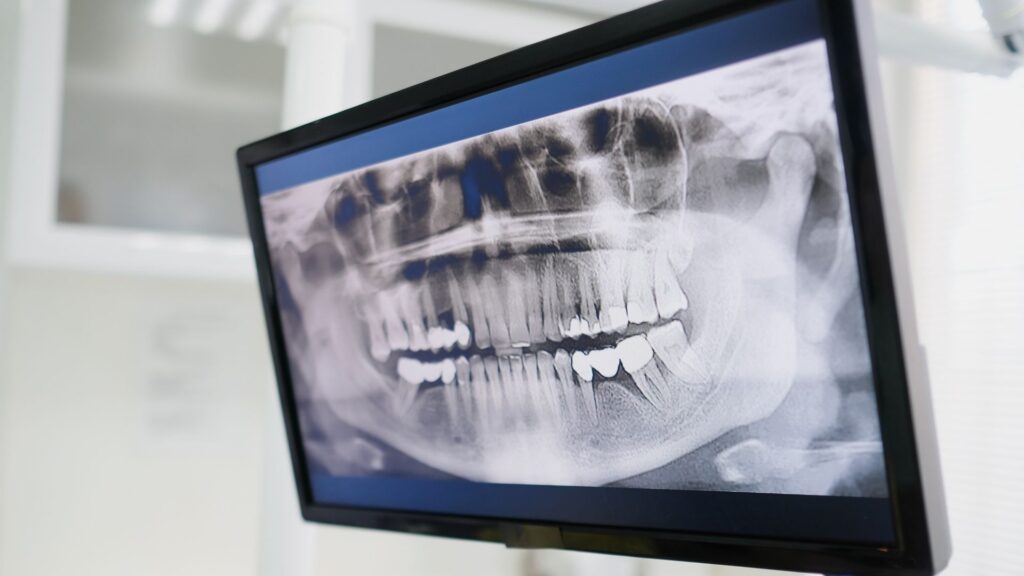 radiografia dental