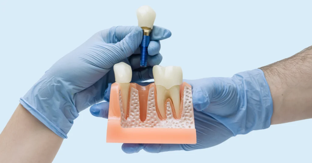 Cuánto dura un implante dental