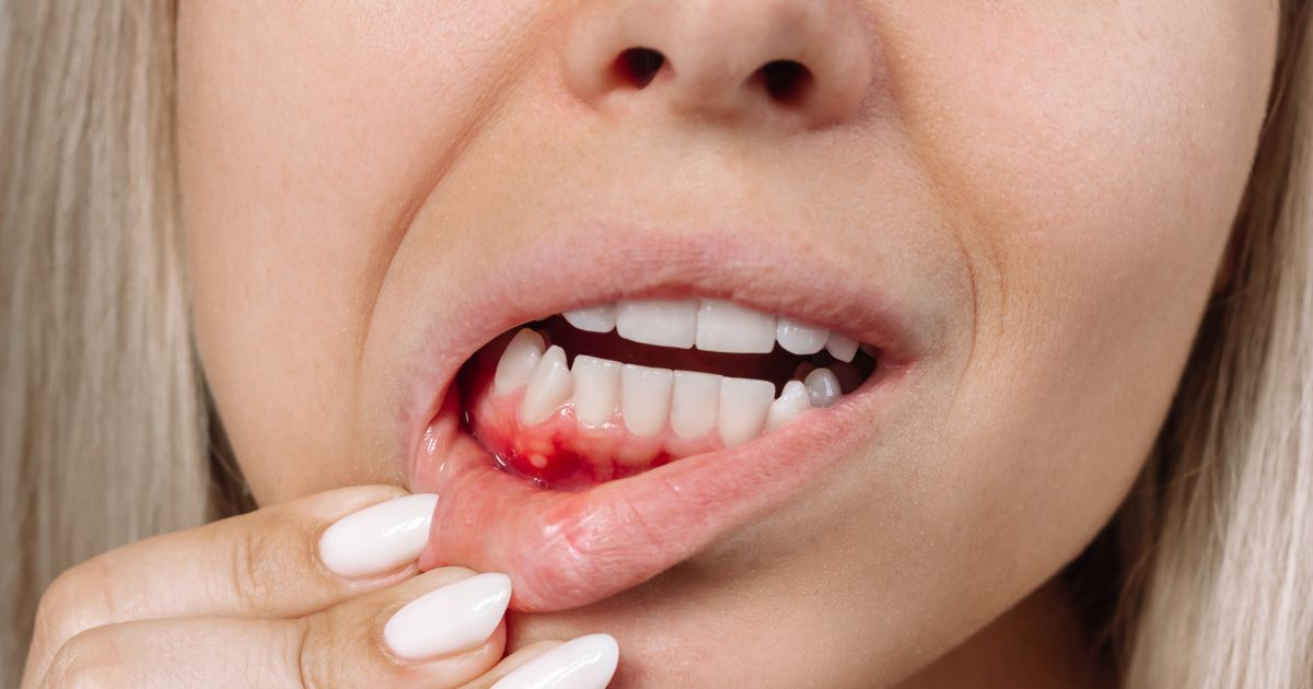Encías inflamadas: causas, síntomas y tratamiento